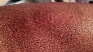 स्किन एलर्जी का देसी इलाज